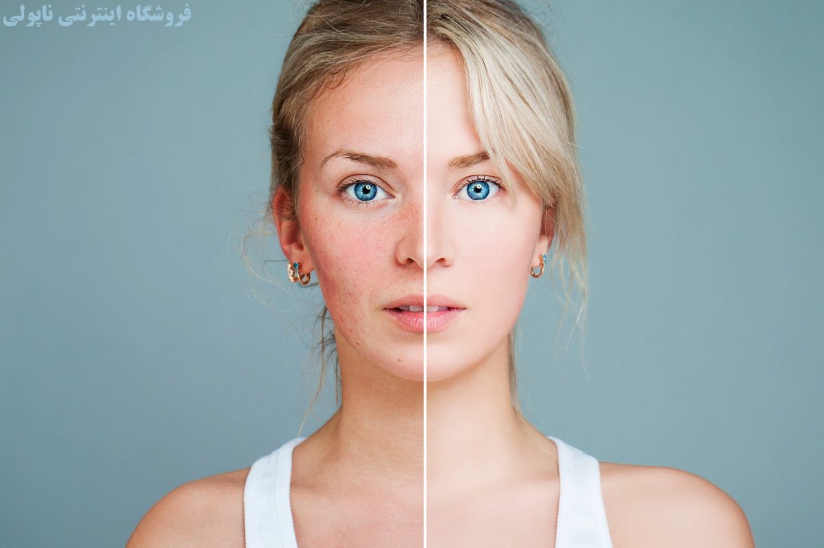 تفاوت پوست دختر جوان قبل و بعد از مراقبت از پوست